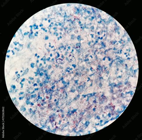 Smear of Acid-Fast bacilli (AFB) stained from human body fluid specimen with positive ...