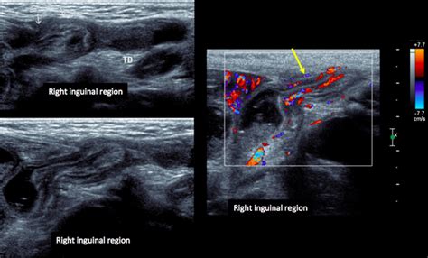 Rt Inguinal Hernia