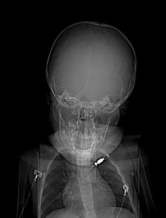 TASER injury to eye | Radiology Case | Radiopaedia.org