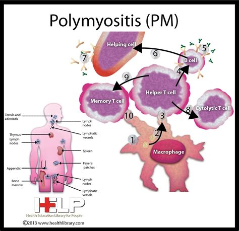 Polymyositis | Ilustración médica, Polimiositis, Enfermedades