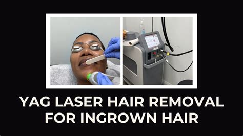 YAG LASER HAIR REMOVAL FOR INGROWN HAIR - YouTube