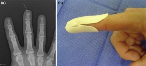 (a) AP radiograph showing a distal tuft fracture (arrow) (b) Typical... | Download Scientific ...