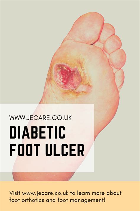 Diabetic Foot Ulcers Diagnosis - JE Care & Consultants Ltd