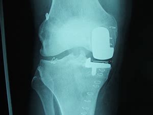 Unicondylar Knee Joint Replacement | Buckinghamshire knee surgery