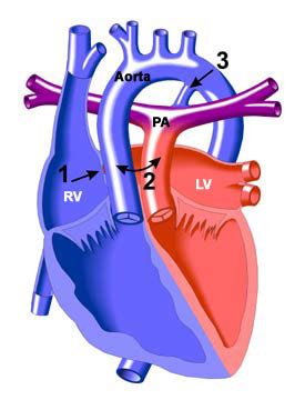 Transposition of the Great Arteries, D-Type | Congenital Heart Disease - Cove Point Foundation ...