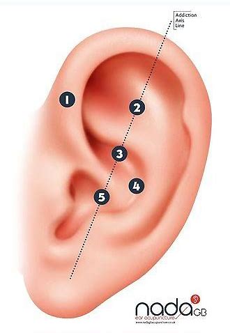 NADA protocol for ear acupuncture