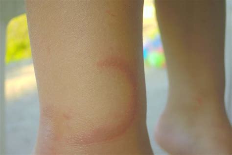 Erythema Nodosum in Children: Symptoms, Causes and Treatment