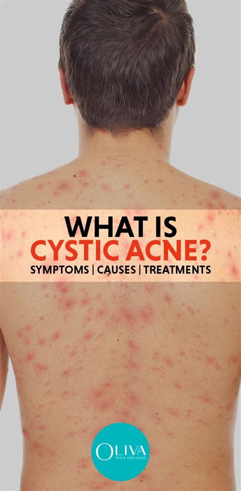 What Causes Cystic Acne On Chest - beckmanfamilyadventures