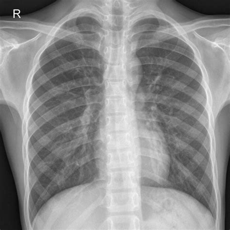 COVID-19 - Kaggle: Chest X-ray (normal) - QMENTA