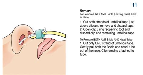 AMT Bridle™ Family | Nasal Tube Retaining Systems, Nasal Bridle