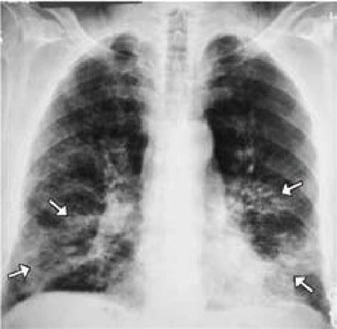 Chest X Ray Consolidation Vs Infiltrate