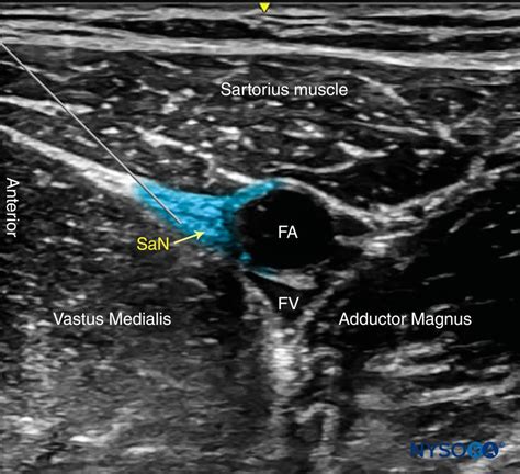 Ultrasound-Guided Saphenous (Adductor Canal) Nerve Block - NYSORA ...