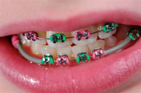 Braces Colors - Which ones right for you?