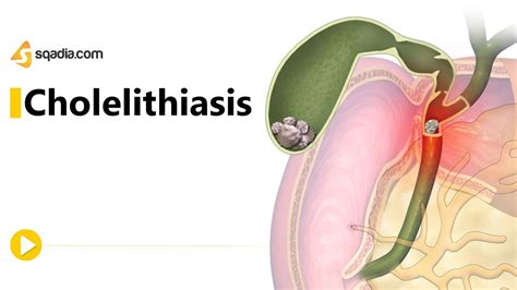 Cholelithiasis -II | Gastroenterology Medicine Animation | Medical V ...