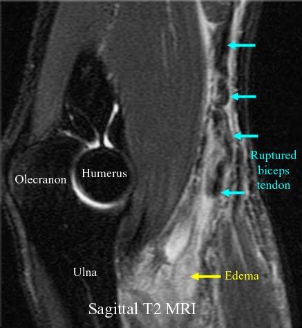 RadiologySpirit: Elbow: Biceps Tendon Rupture on MRI Scan