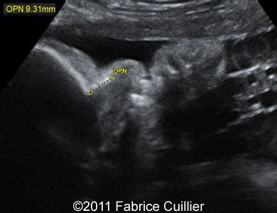 📃 Atypical signs of Beckwith-Wiedemann syndrome