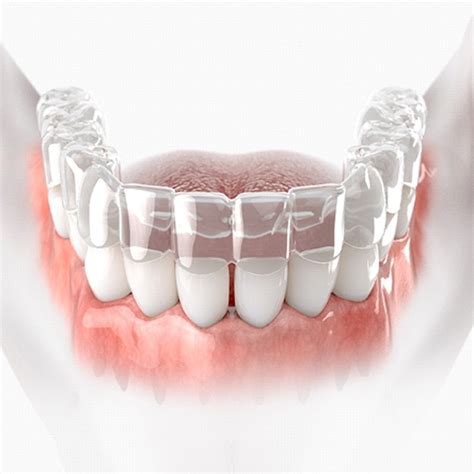 Clear Braces Shelton | SureSmile Aligners | Dental Center of Huntington