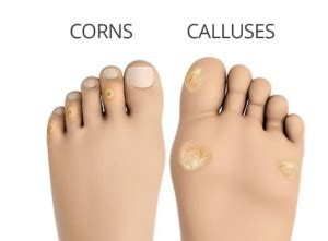 Corn and calluses - Stride Health