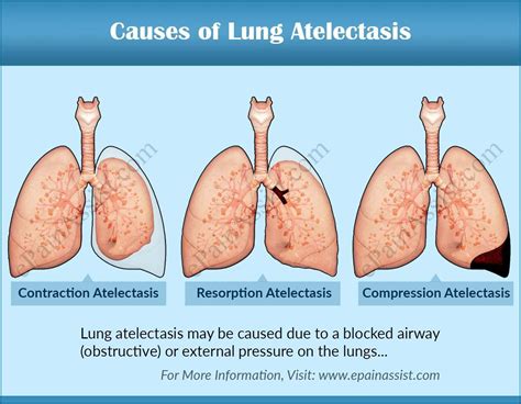 Causes of Lung Atelectasis | Medical ultrasound, Emergency nursing, Medical school studying