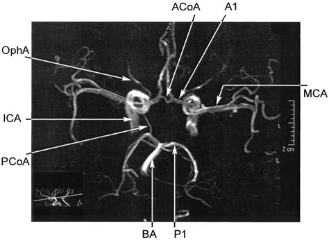 MRA Brain anatomy | Radiology Anatomy Images | Brain anatomy, Anatomy images, Anatomy