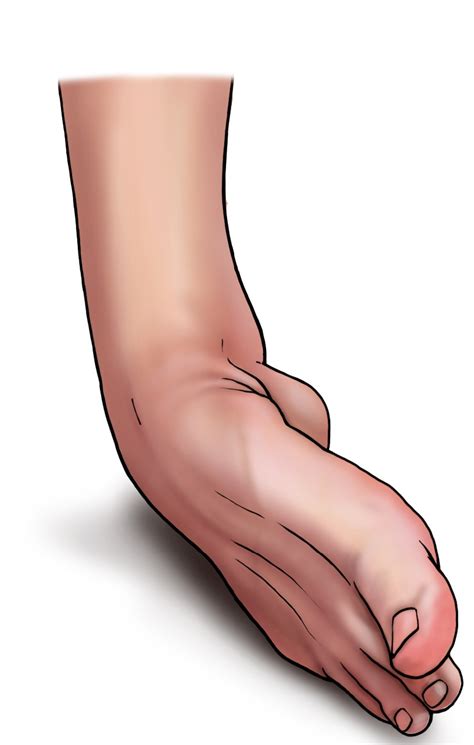 Sprained Ankle | Argentina| PDF | PPT| Case Reports | Symptoms | Treatment