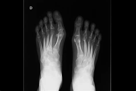 X Ray Of Foot