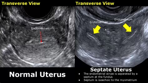 Congenital Uterine Abnormalities Ultrasound Normal Vs Abnormal Image Appearances | Uterus USG ...