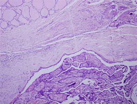 Thyroglossal Duct Cyst Histology