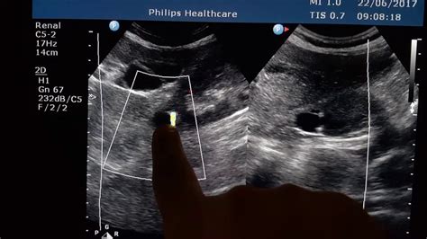 Milk Of Calcium Cyst Ultrasound