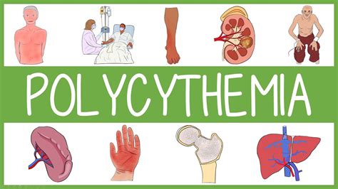 Polycythemia: Clinical Features, Management and Mnemonics - YouTube