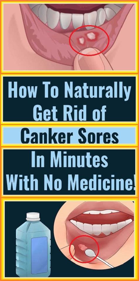 Canker sores can appear at any time and often for no apparent reason ...