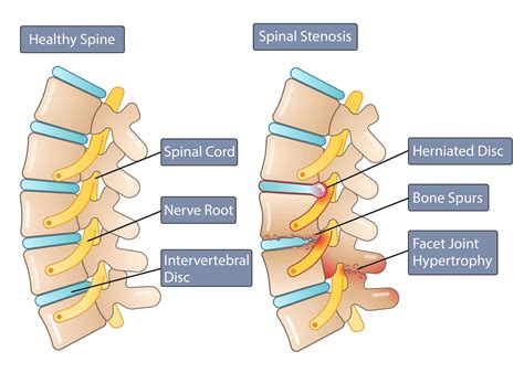 Non-Surgical Sciatica Relief: Spinal Stenosis Solutions (Part 2)