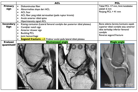 ACL and PCL tear MRI – radiologi.id