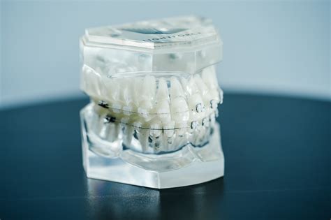 Lightforce Clear Braces | Braces Marietta | Levin Orthodontics