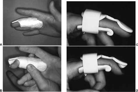 Finger PIP Splints - Extremity Splinting - Mitch Medical