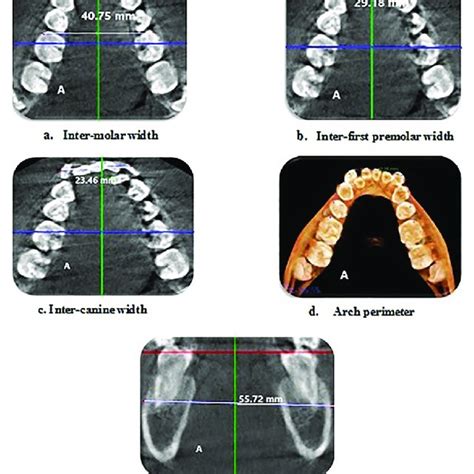 (a) Quad helix maxillary expander used in the study; (b) Hyrax ...