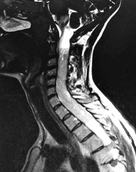 T1 weighted MRI with brain demonstrating the syringomyelia superior to... | Download Scientific ...