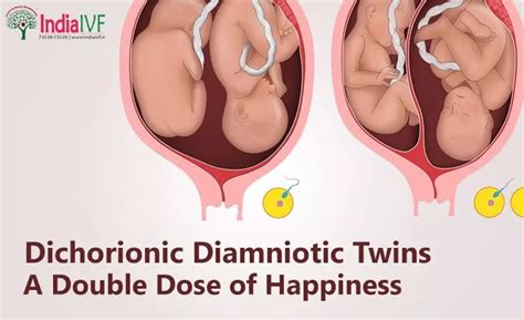 Dichorionic Diamniotic Twins: A Double Dose of Happiness | India IVF ...