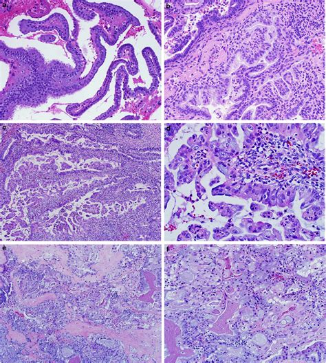 Histological classifications of endometrial mucinous lesions: simple... | Download Scientific ...