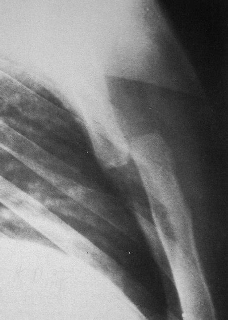 Sternum Pain (Breastbone) - Causes (Under, behind area)