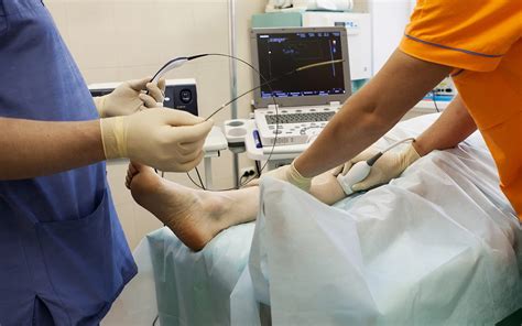 Radiofrequency Ablation Treatment - Why Consider For Varicose Veins?