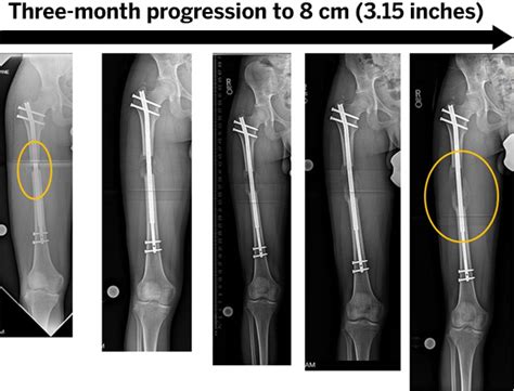 Limb Lengthening Surgery | HSS Orthopedics Ranked #1 in US