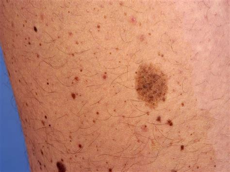 Nevus spilus causes, symptoms, diagnosis & treatment