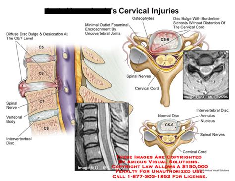 AMICUS Illustration of amicus,injury,cervical,diffuse,disc,bulge,desiccation,C6/7,spinal,nerve ...