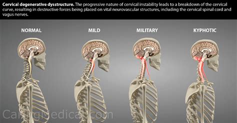 Vagus nerve compression in the neck: Symptoms and treatments