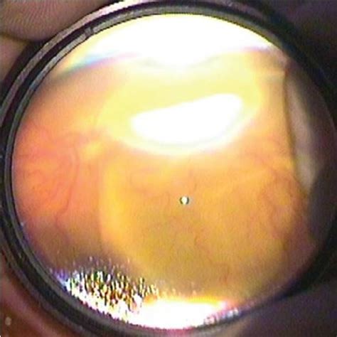 Exudative retinal detachment in right eye | Download Scientific Diagram