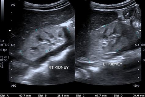 Glomerulonephritis Ultrasound