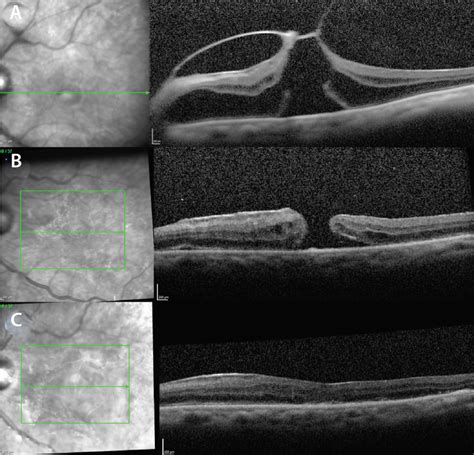 Vitrectomy With Cutter-only ILM Peel During Full-thickness Macular Hole ...