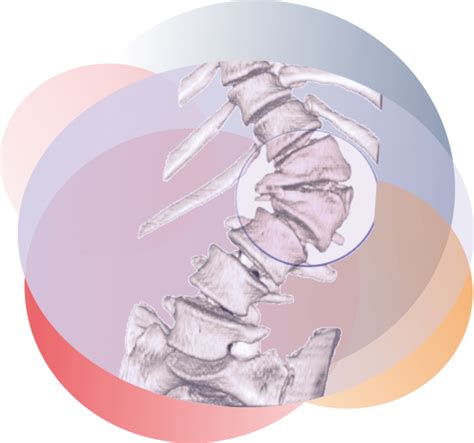 Congenital Scoliosis