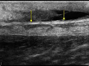 Musculoskeletal Joints and Tendons | 6.7 Ankle : Case 6.7.4 Full thickness achilles tendon ...